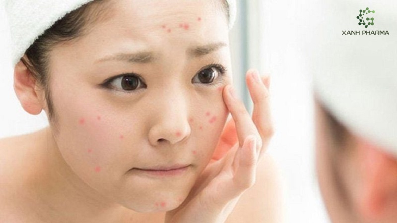 Uống collagen có gây nổi mụn?