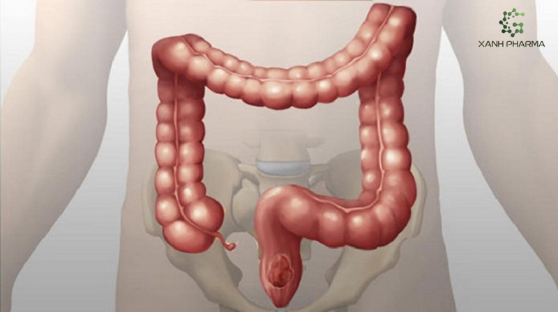 Vai trò của prebiotic với người bệnh viêm ruột